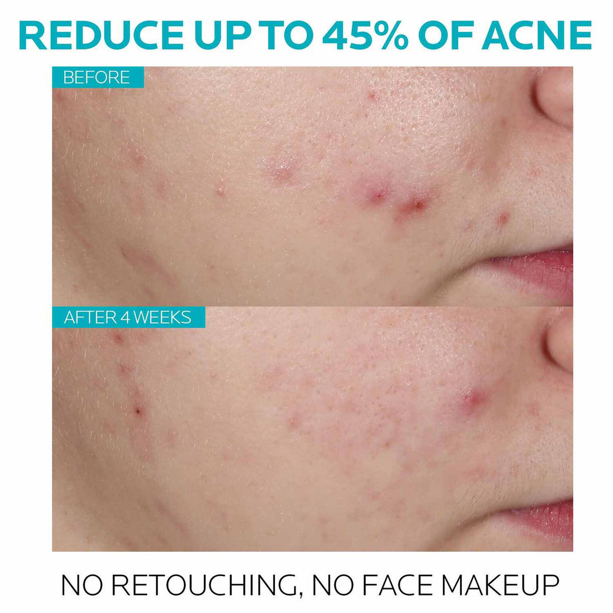 effaclar-salicylic-acid-acne-treatment-serum-l1 7_EffaclarSerum_After-45-days.jpg 7_EffaclarSerum_After-45-days_861b20986157.jpg