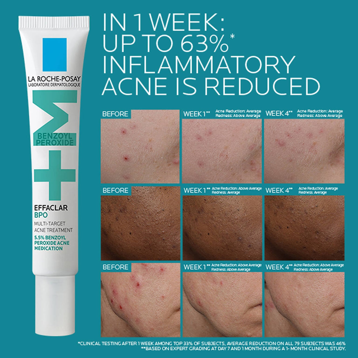effaclar-bpo-multi-target-acne-treatment-with-5-5-benzoyl-peroxide-z4 EffaclarBPO-ClinicalBA-ATF-1500x1500-2.jpg EffaclarBPO-ClinicalBA-ATF-1500x1500-2_24504e8de09c.jpg