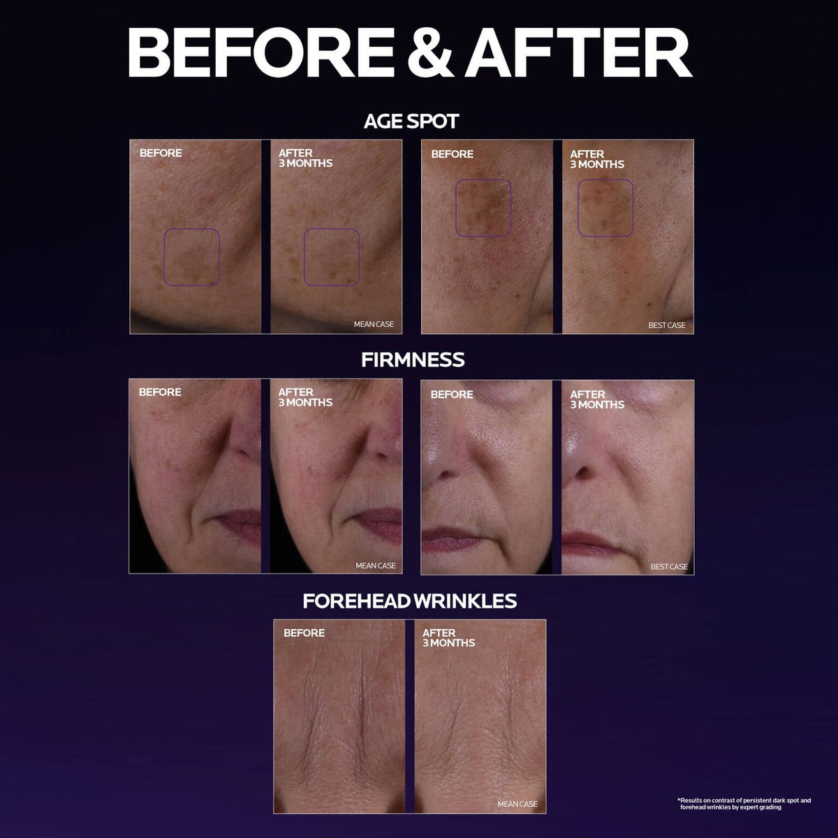mela-b3-double-dose-discoloration-treatment-with-melasyltm-r2 MelaB3_DD_BTF_BeforeAfter_1500x1500_5.jpg MelaB3_DD_BTF_BeforeAfter_1500x1500_5_eb9d4f5b0787.jpg